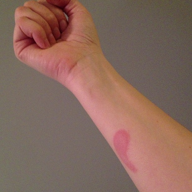 Yep, thats a burn in the shape of a comma, forever scarred into my arm